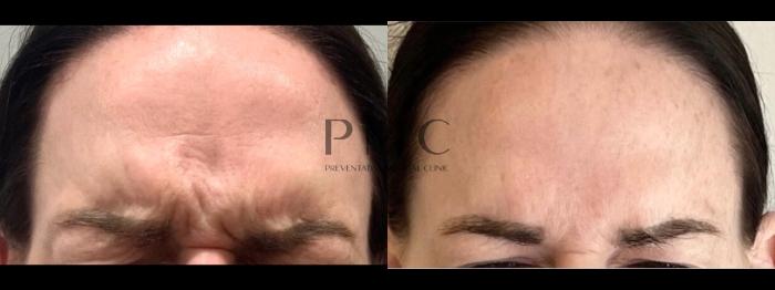 Botox in the Glabella