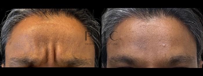 Botox in the Glabella