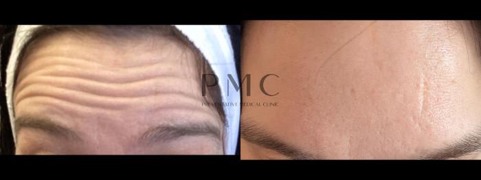 Botox in the Forehead