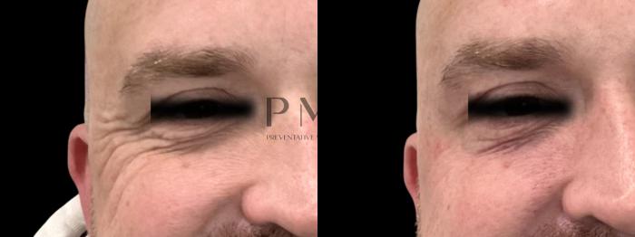 Botox in the Crows Feet
