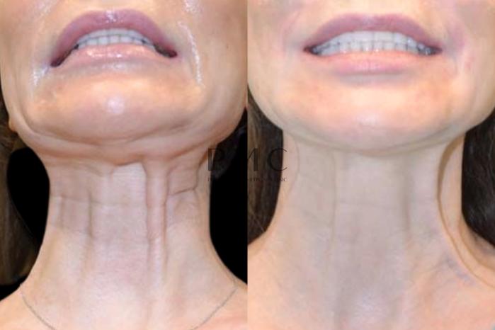 Botox in the Platsyamal Bands