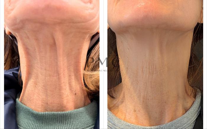 Before & After BOTOX® Nefertiti Neck Lift (Platysmal Bands) Case 3 Front View in Omaha, NE