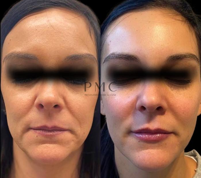 1 Syringe of Voluma & 1 Syringe of Juvederm XC