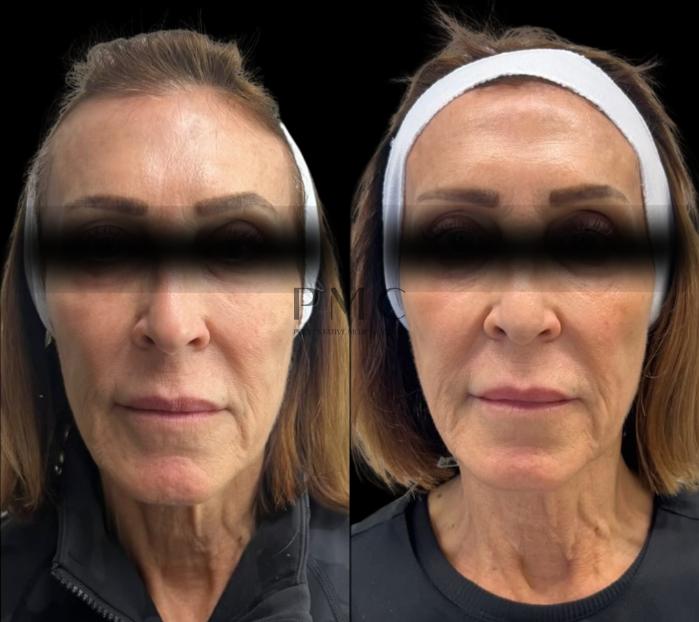 4 Treatments of EMFACE