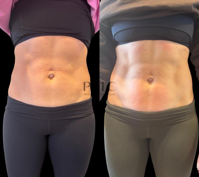 4 Treatments of EMSCULPT-NEO
