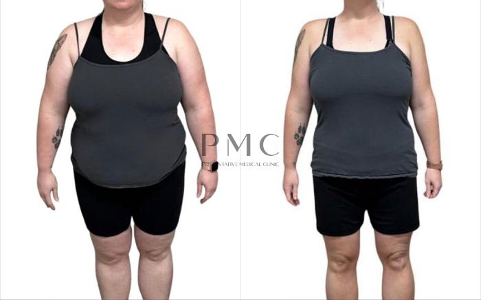 Before & After GLP-1 Weight Loss Case 4 Front View in Omaha, NE