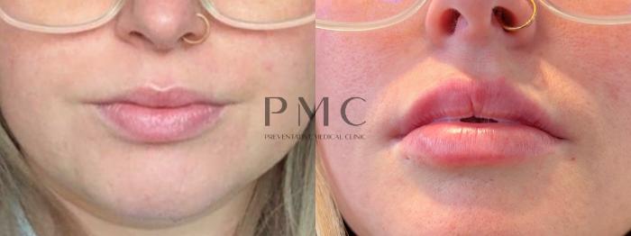 1 Syringe of Juvederm XC in the lips