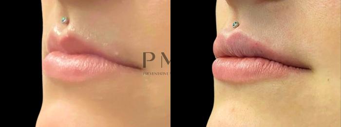 1 Syringe of Juvederm XC in the lips