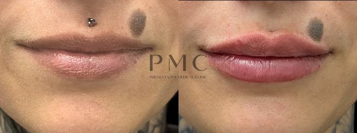 Before and After of 1 Syringe of Juvederm XC in the lips