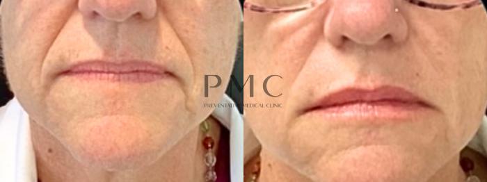 1 Syringe of Juvederm XC in the lips