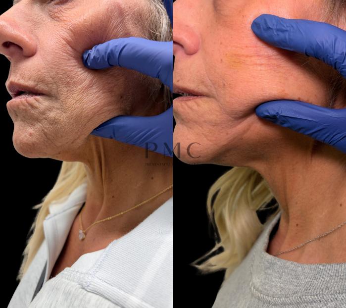 2 Syringes of Sculptra