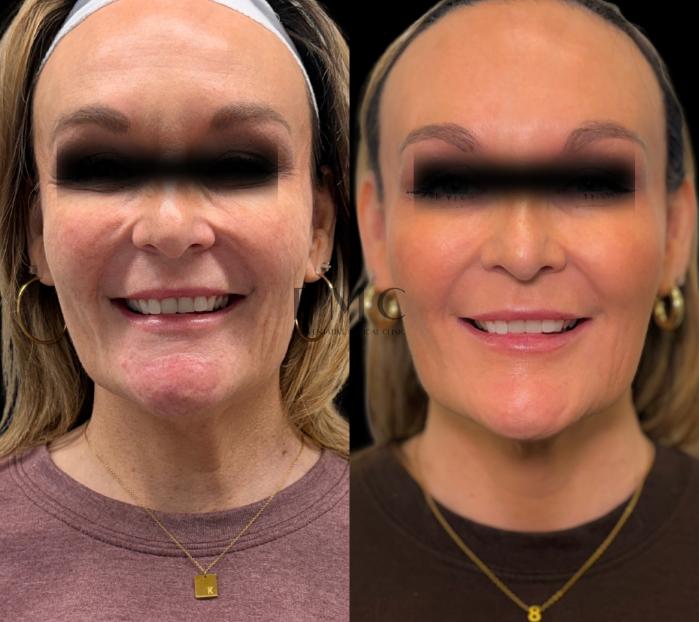 2 Syringes of Sculptra