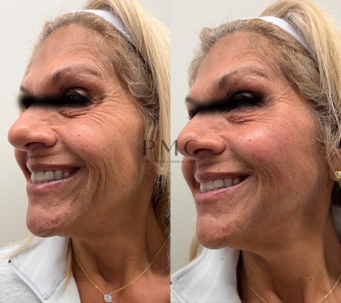 2 Syringes of Sculptra