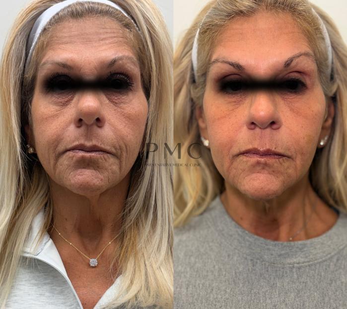 2 Syringes of Sculptra