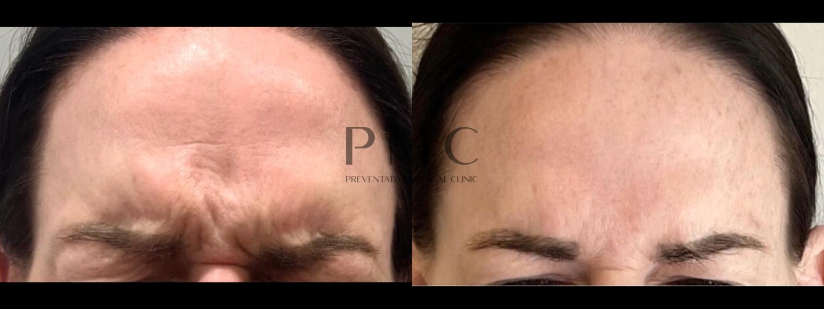 Botox in the Glabella