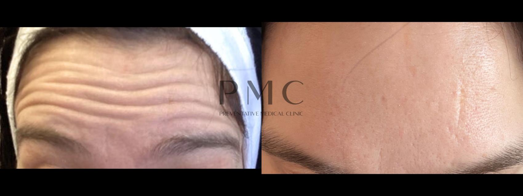 Botox in the Forehead