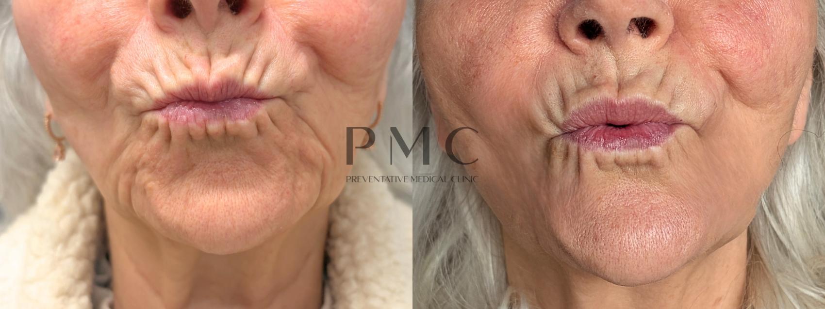 1 Syringe of Juvederm Volbella