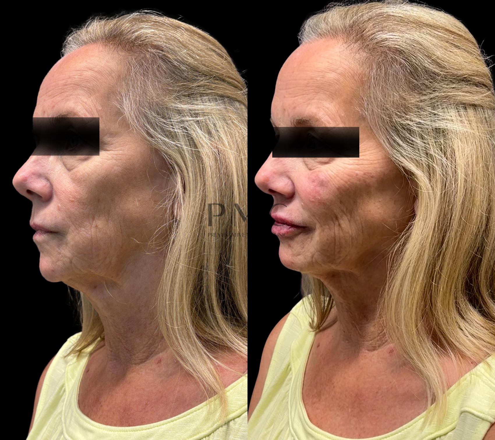 1 Syringe of Voluma & 1 Syringe of Juvederm XC