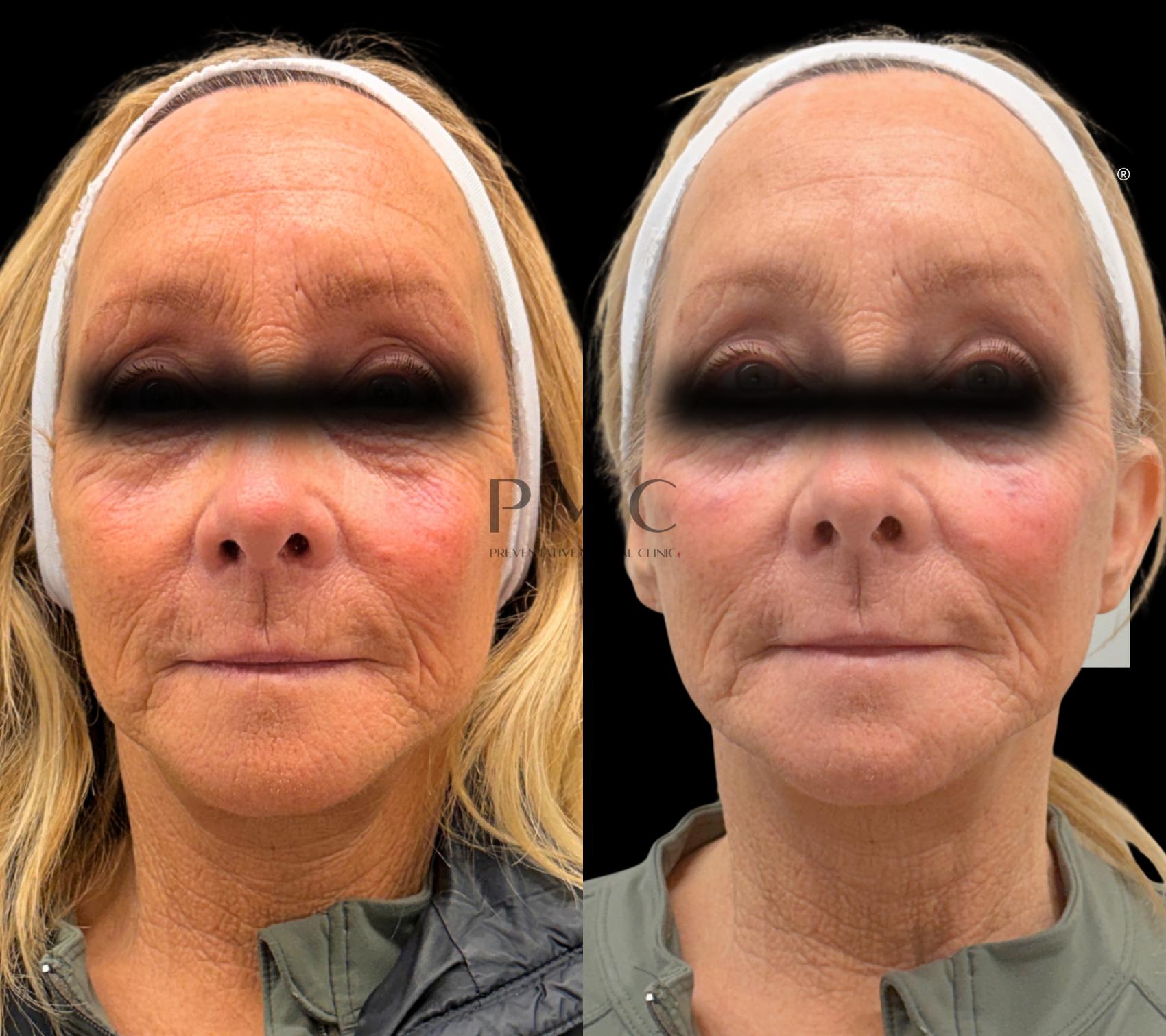 1 Syringe of Voluma & 1 Syringe of Volux