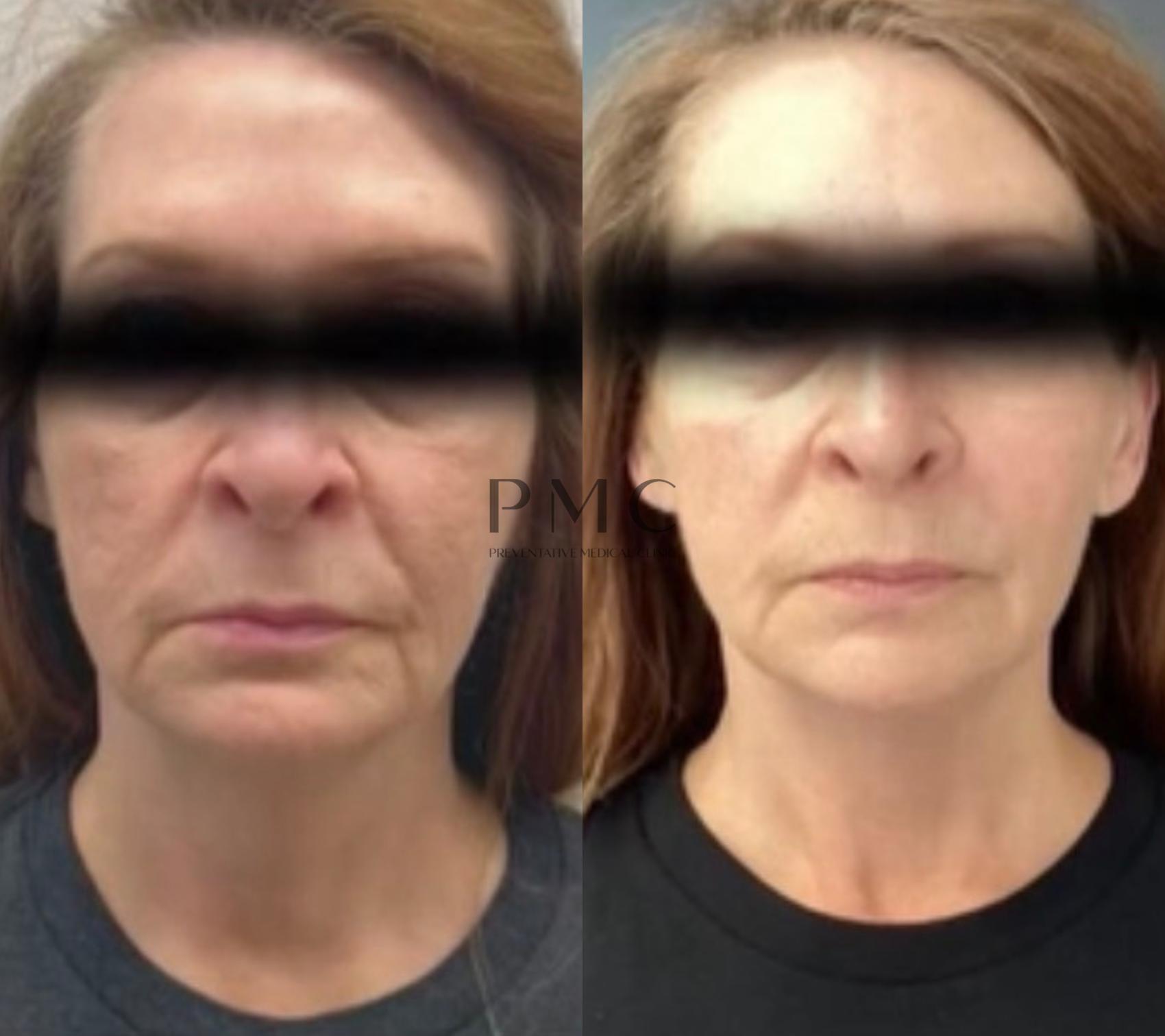 4 Treatments of EMFACE