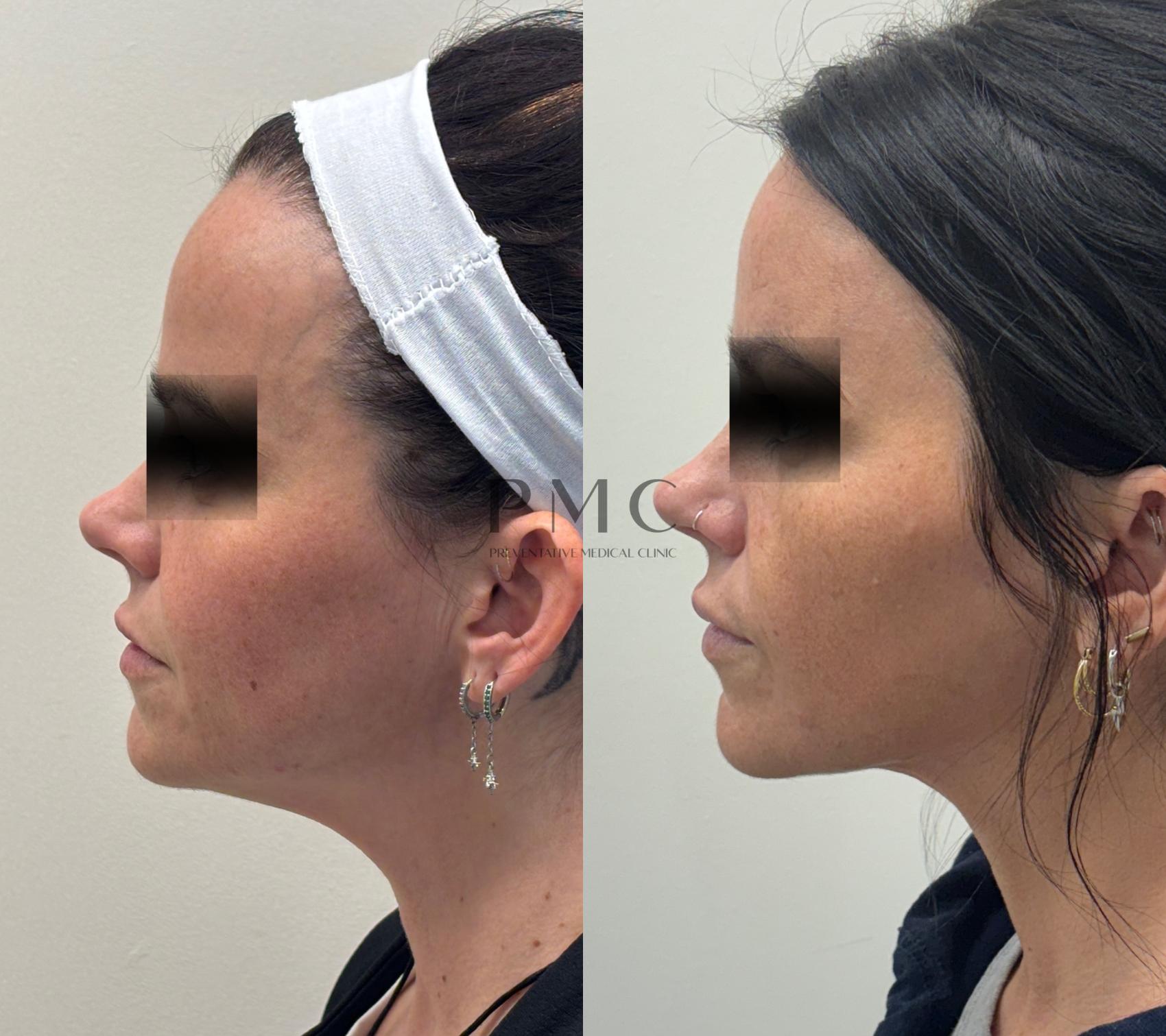 4 Treatments of EMFACE