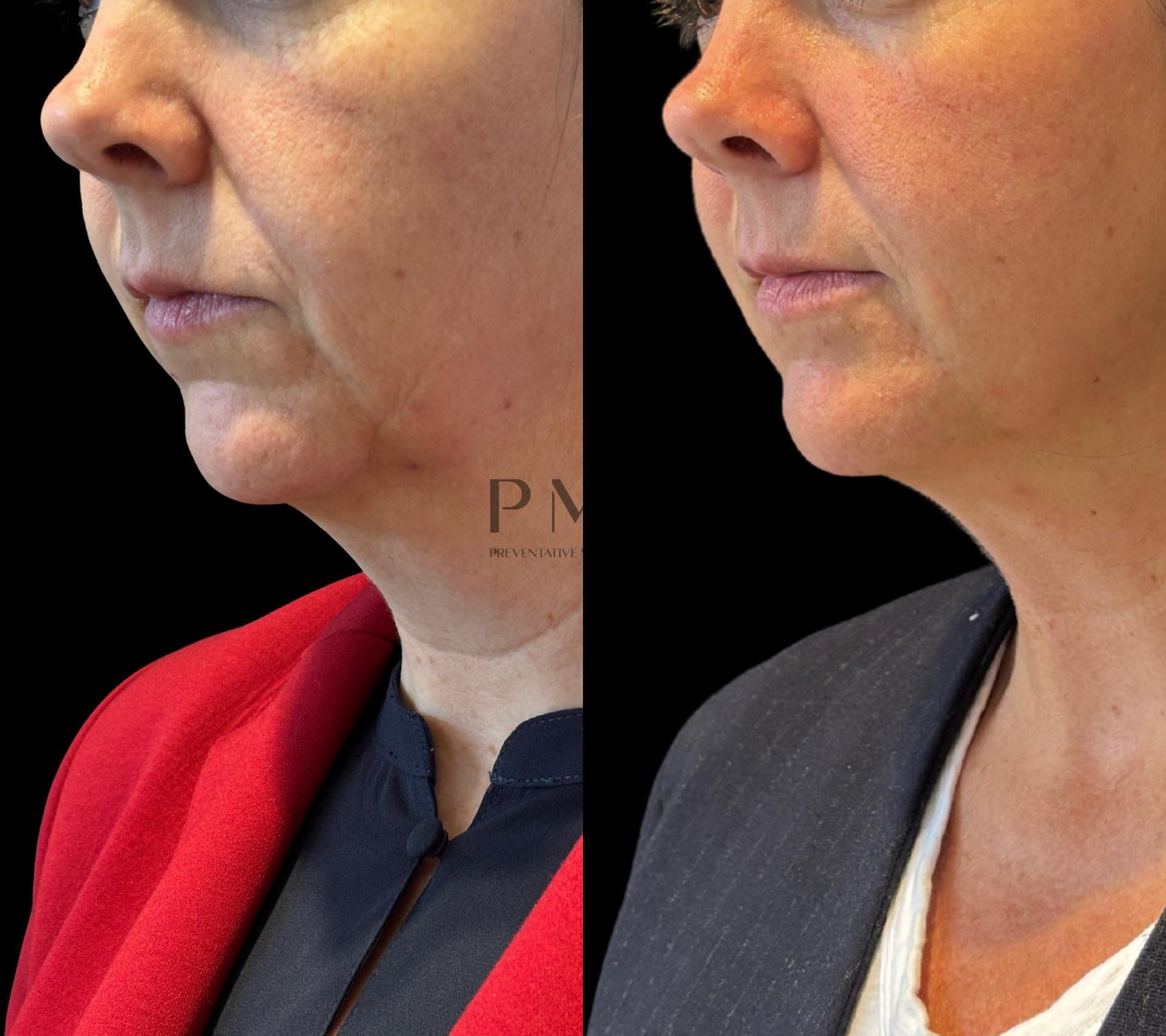 4 Treatments of EMFACE