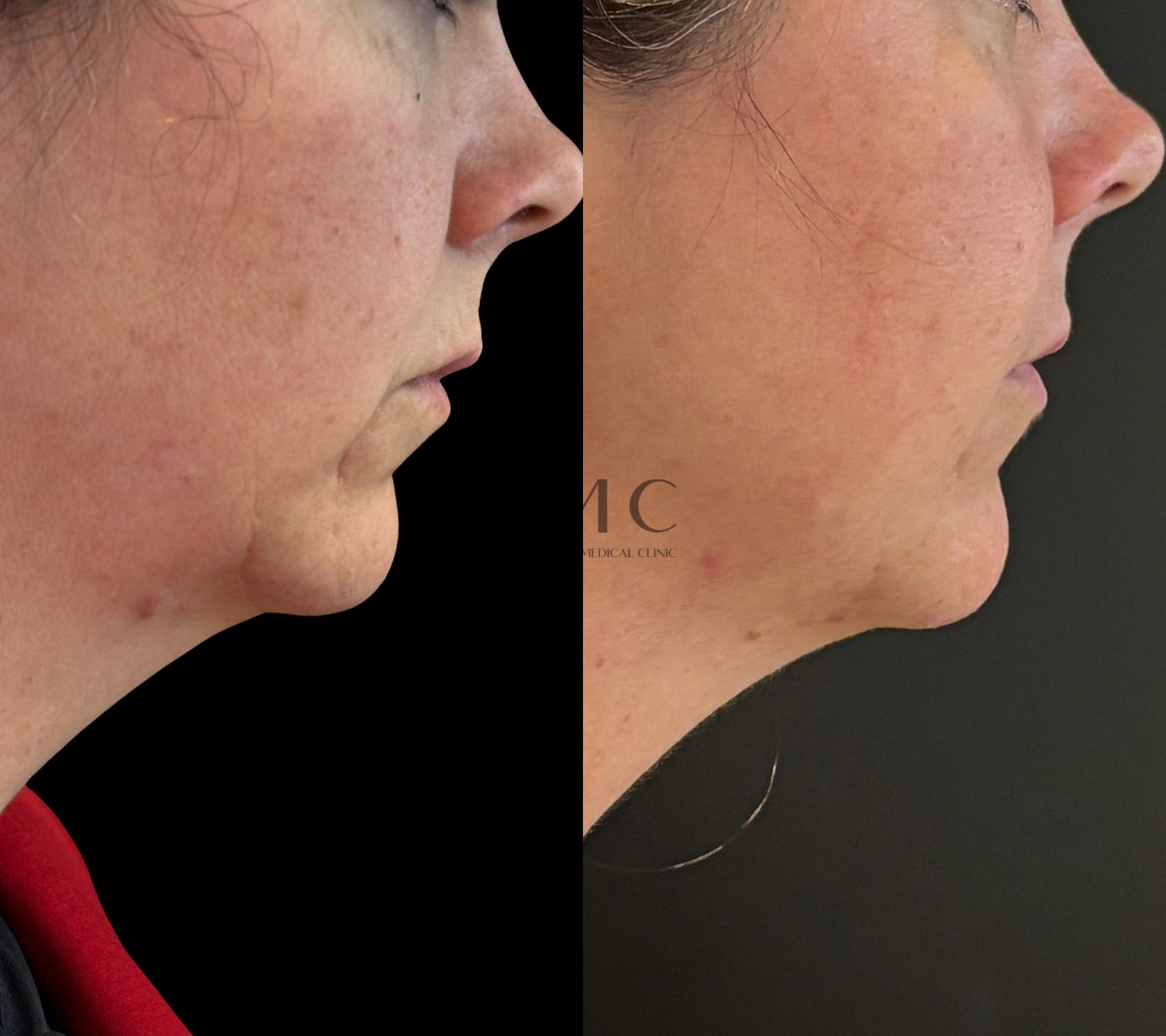 4 Treatments of EMFACE