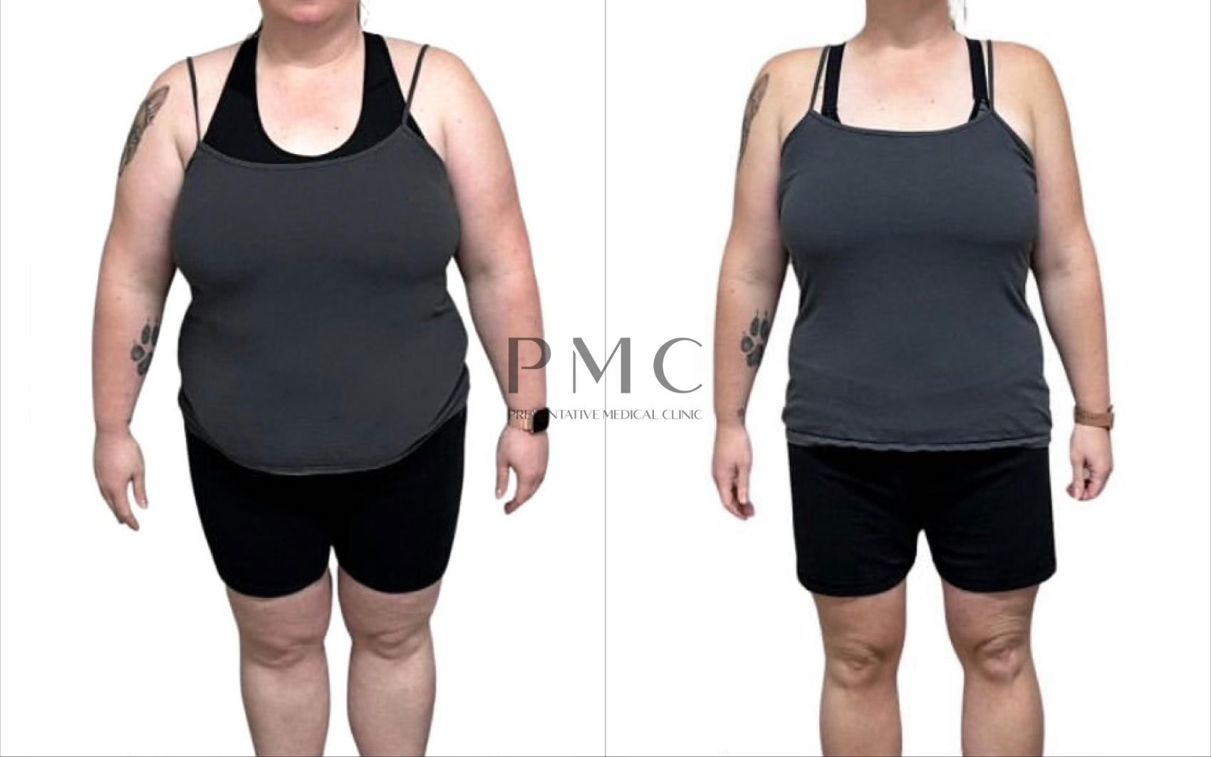 Before & After GLP-1 Weight Loss Case 4 Front View in Omaha, NE