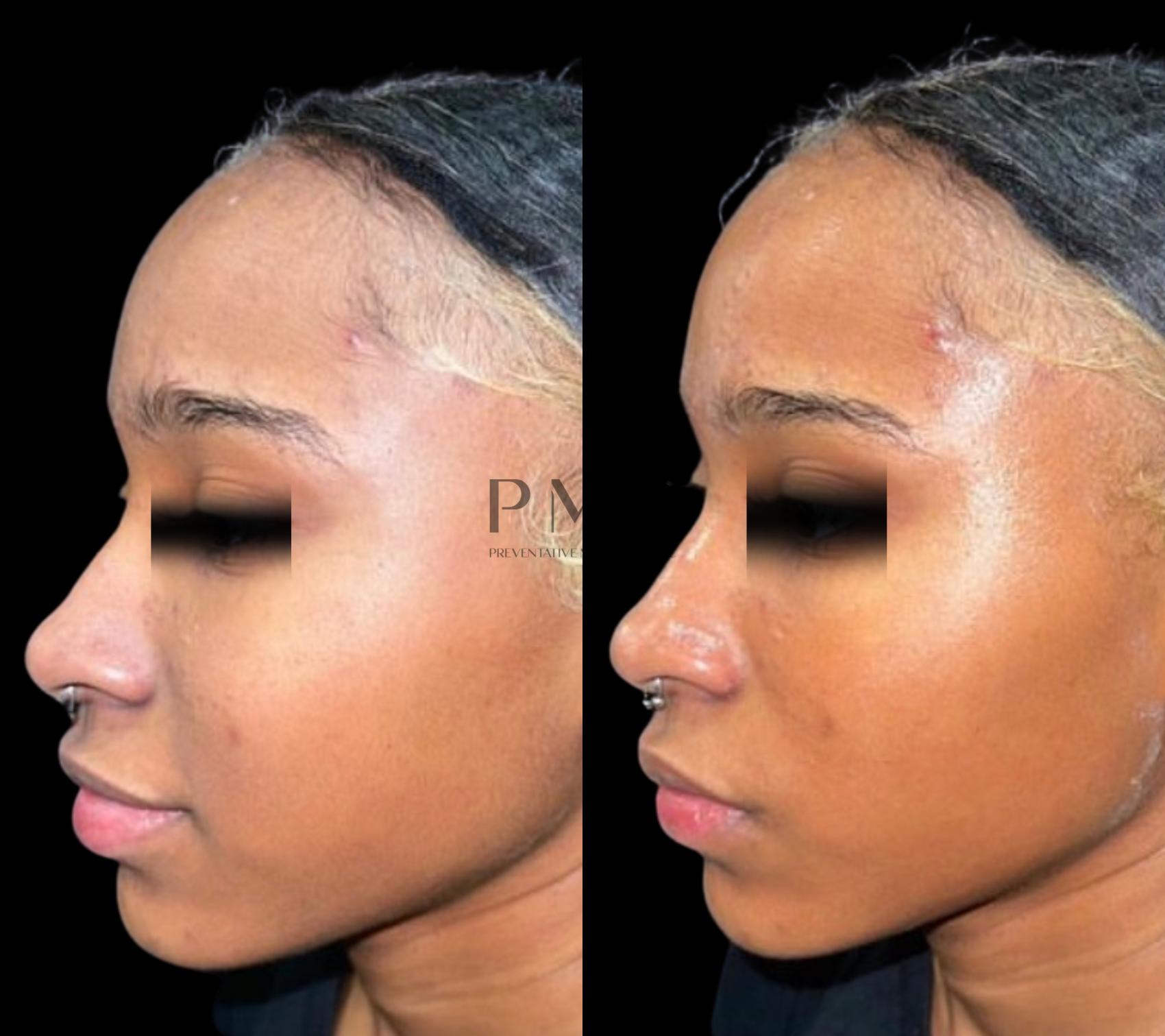 1 Treatment of HydraFacial