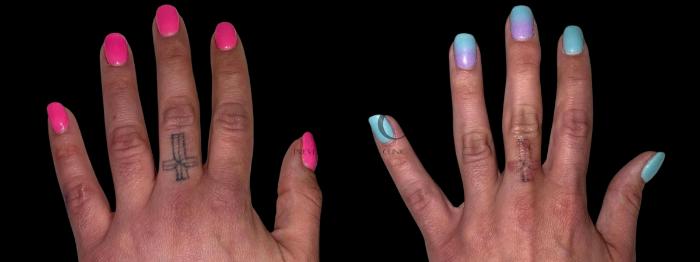 2 Treatments of Tattoo Removal