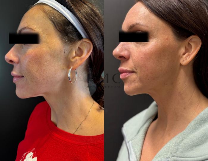 1 Treatment of EXION Clear Laser
