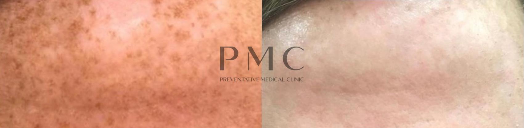 2 Treatments of AFT/DYE-VL Laser 