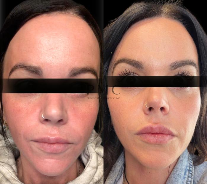 3 Treatments of LASEMD