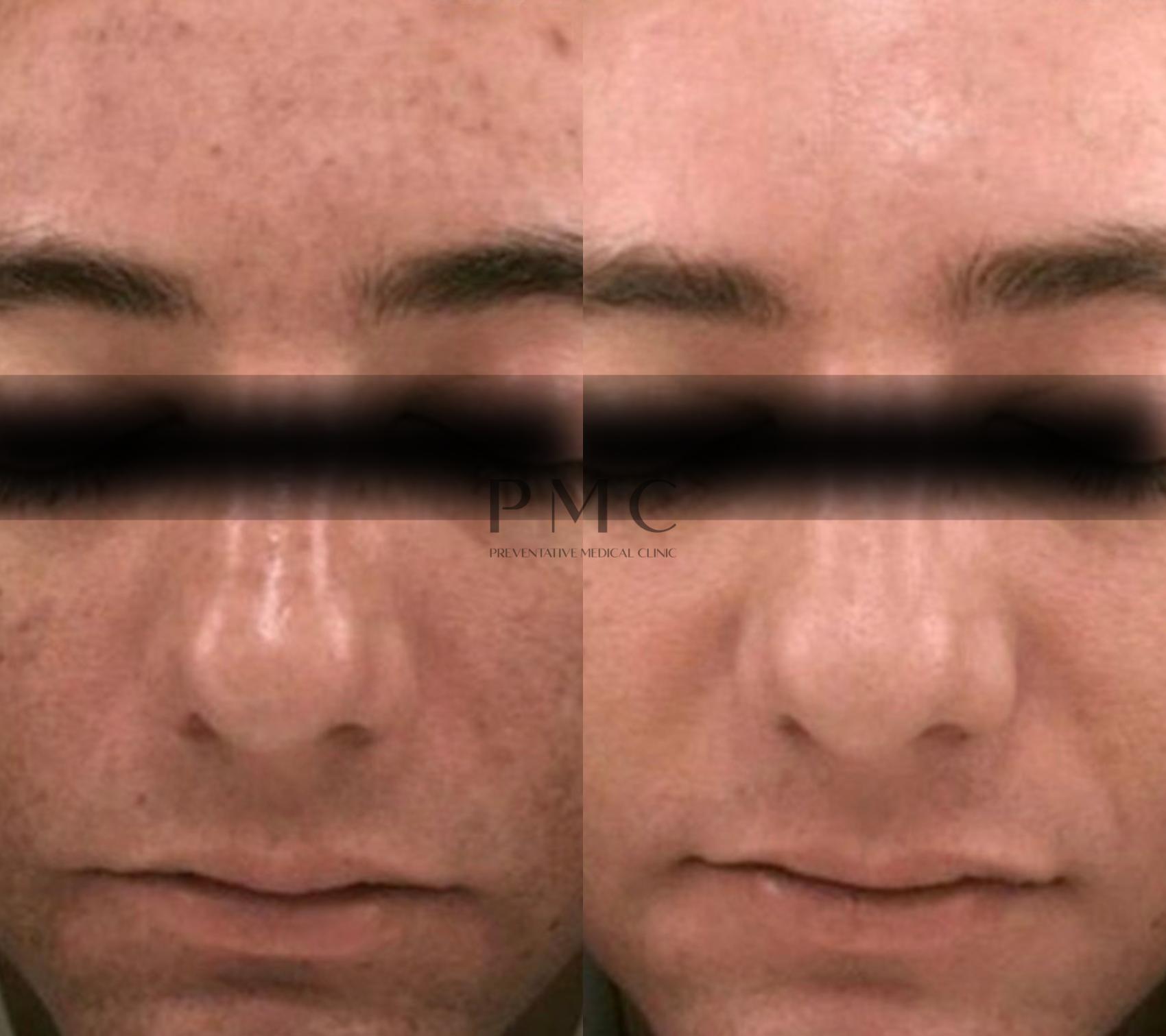 1 Treatment of PRP Vampire Facial