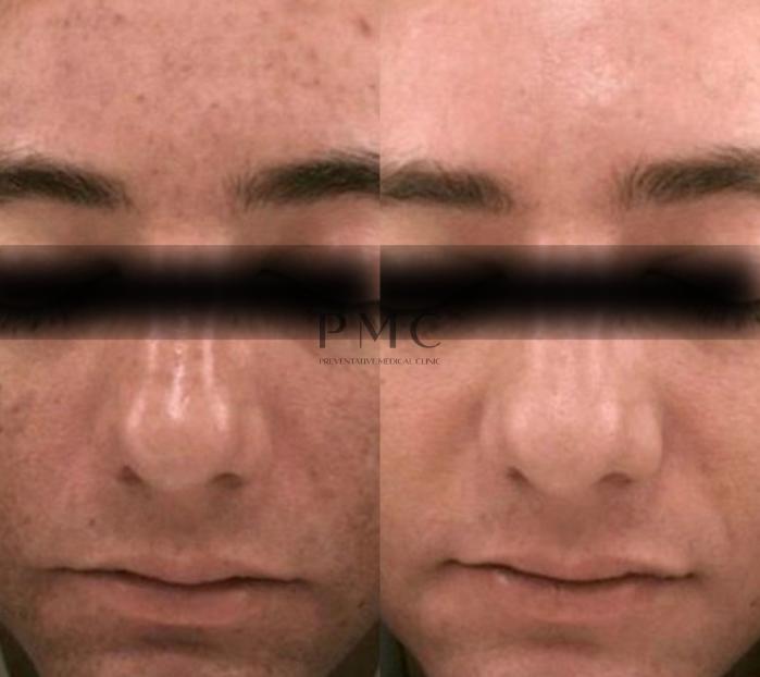1 Treatment of PRP Vampire Facial