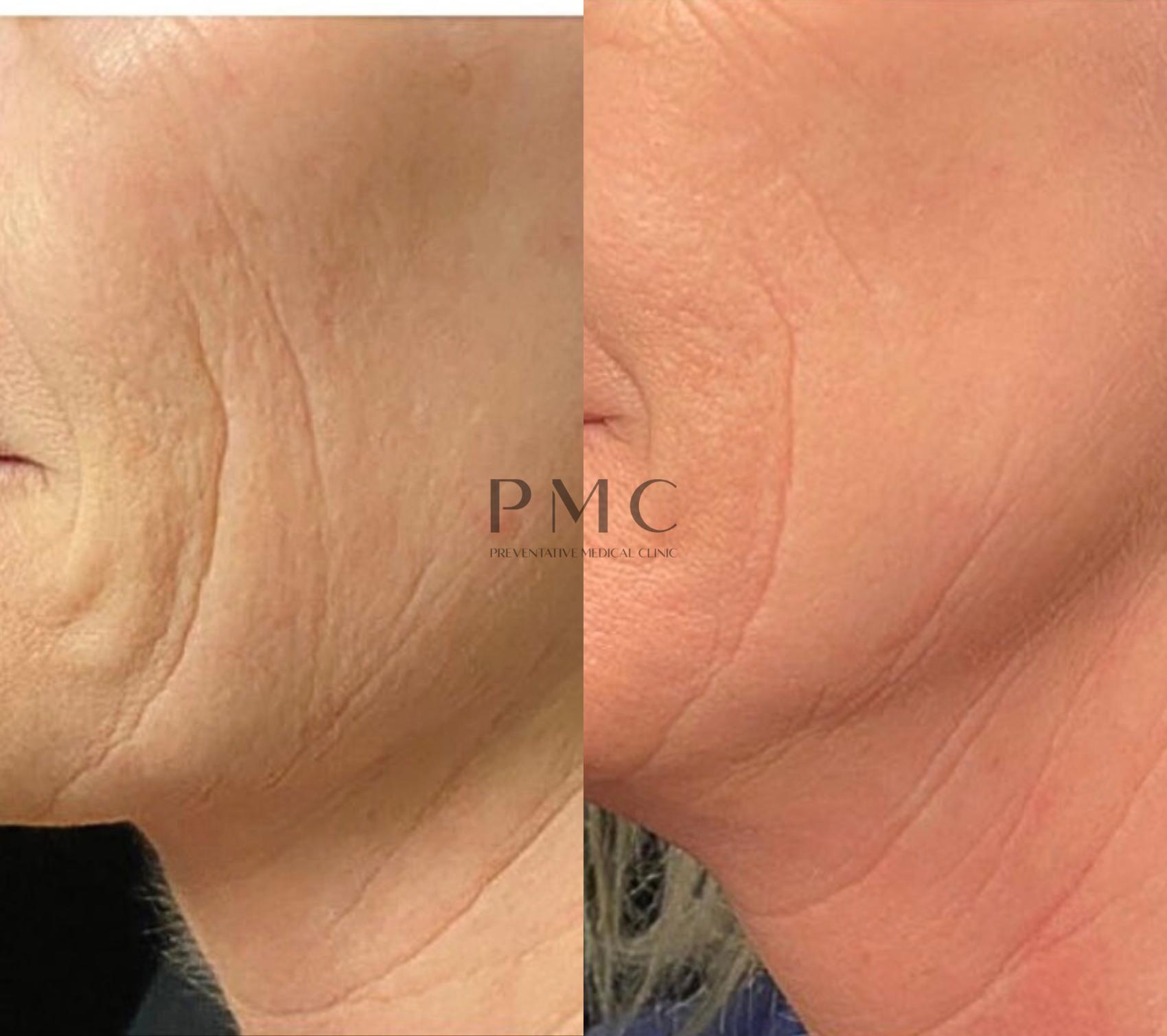 1 Treatment of Opus Laser 