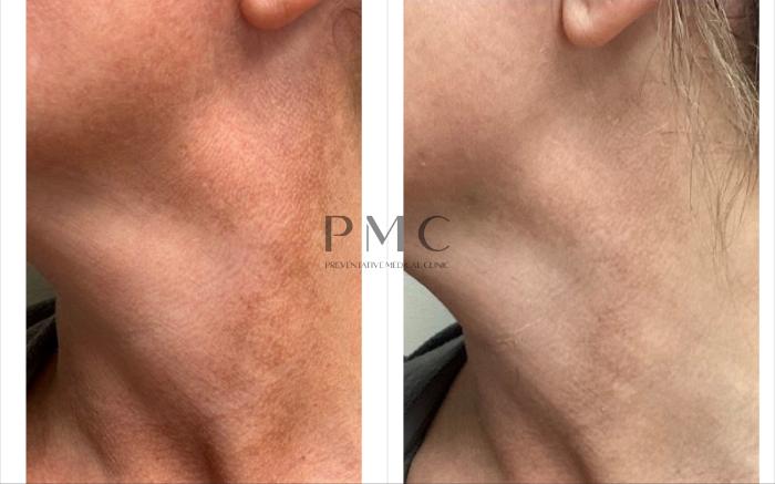 Before & After Laser Skin Treatments Case 6 Front View in Omaha, NE
