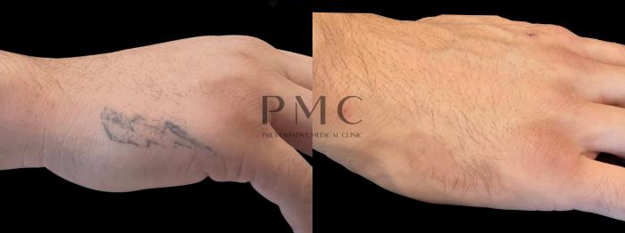 4 Treatments of a Tattoo Removal Treatment