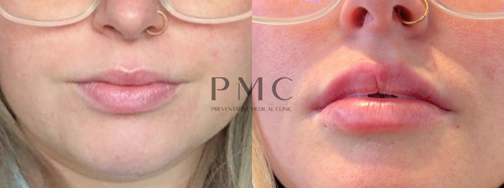 1 Syringe of Juvederm XC in the lips