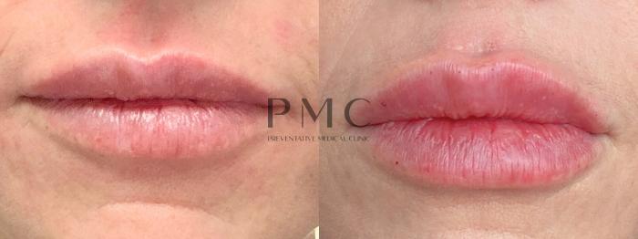 1 Syringe of Juvederm SkinVive