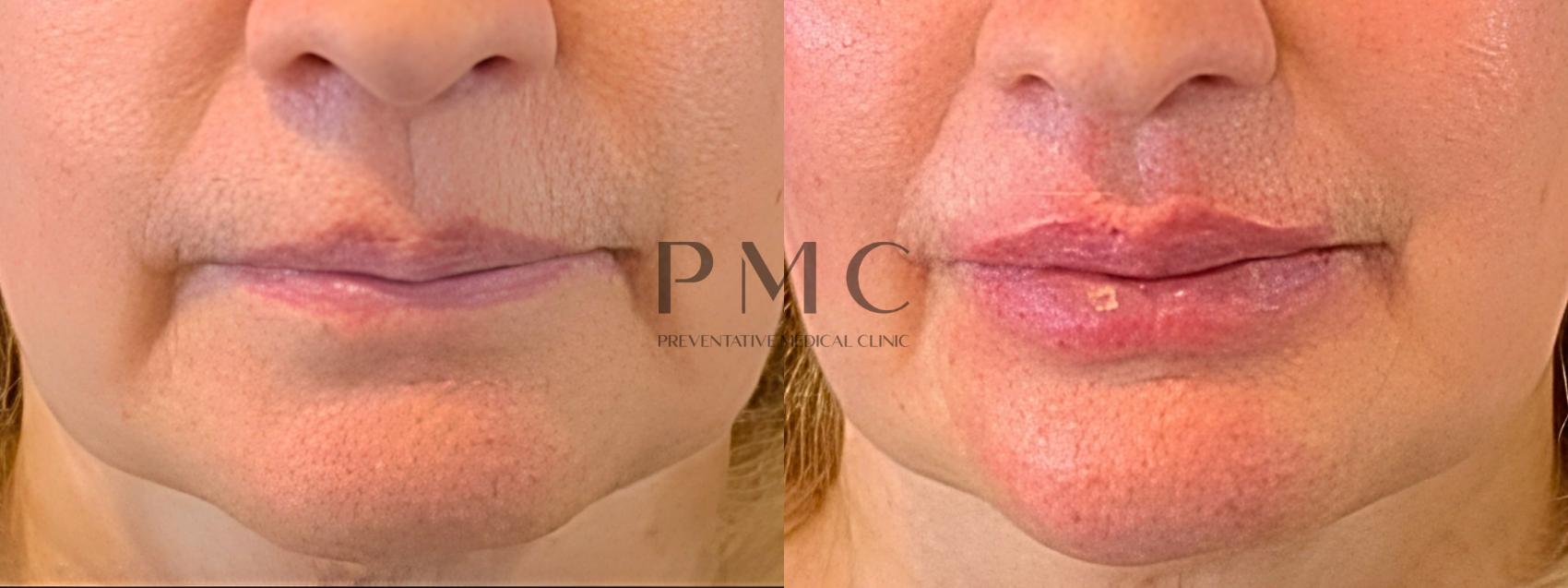 2 Syringes of Juvederm XC