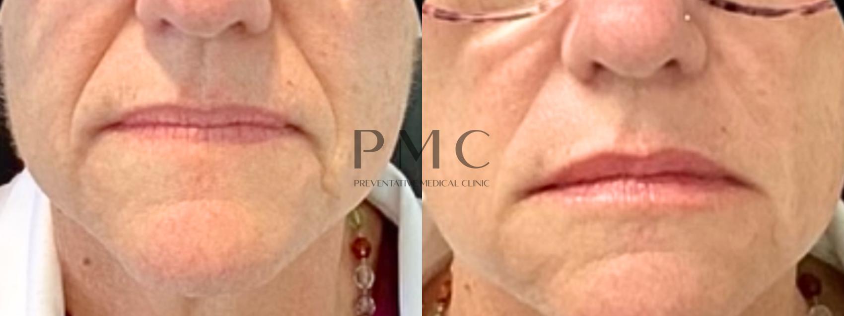 1 Syringe of Juvederm XC in the lips