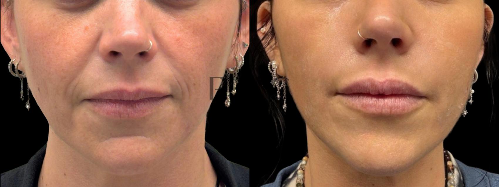 2 Syringes of Juvederm XC in Nasiolabial Folds