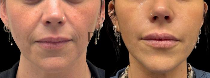 2 Syringes of Juvederm XC in Nasiolabial Folds