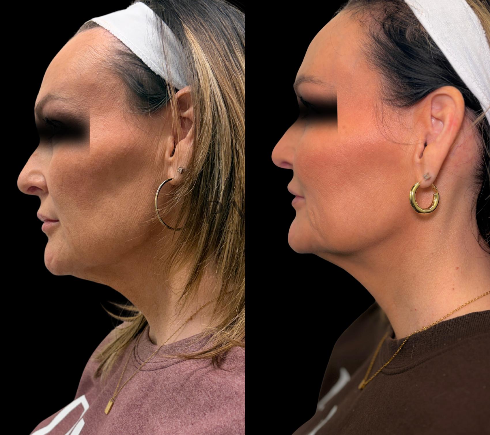 2 Syringes of Sculptra